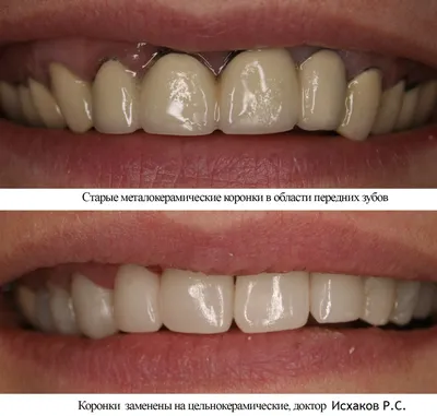 Ремонт зубных протезов и коронок в Уфе | Стоматологическая клиника «Маэстро»