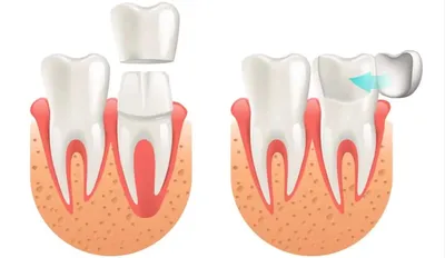 Чем отличаются виниры от коронок? Что лучше ставить на поврежденный зуб?