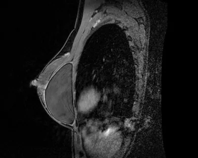 МРТ молочных желез в СПб: что показывает и когда назначается