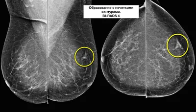 BI-RADS — исследование молочных желез — 24Radiology.ru