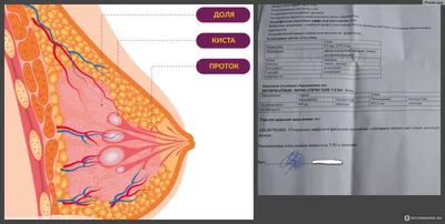 УЗИ (Ультразвуковое исследование) молочных желез - «19 дней моего  персонального ада. Ожидание хуже возможного приговора. С какими СИМПТОМАМИ  нужно бежать к врачу, а кому и без симптомов не мешало бы лишний раз