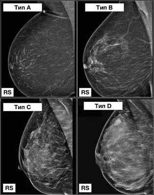 BI-RADS — исследование молочных желез — 24Radiology.ru