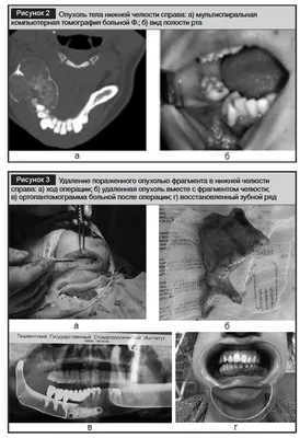 Резекция нижней челюсти и реконструкция нижней челюсти с применением  аутотрансплантата из подвздошной кости. - Челюстно лицевая хирургия