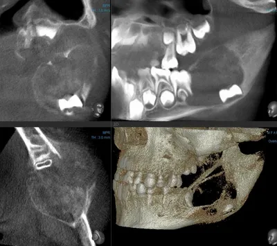 PDF) Ameloblastic carcinoma of lower jaw (case report)