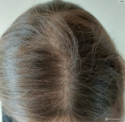 Уход за волосами в домашних условиях (маски, пилинги и т.д.) - «Уход за  волосами при андрогенной алопеции. Что действительно помогло, а что  оказалось бесполезным. Сущность и лечение заболевания.» | отзывы