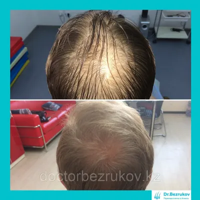 Лечение выпадения волос у мужчин (id 1015507)