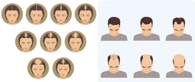 Выпадение волос у женщин — лечение, как остановить