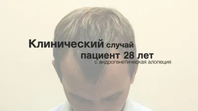 Применение мезотерапевтического метода коррекции выпадения волос | Портал  1nep.ru