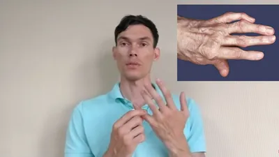 АРТРОЗ ПАЛЬЦЕВ РУК РАЗРАБОТКА arthrosis of the fingers - YouTube