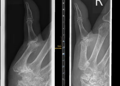 Артроз седловидного сустава большого пальца кисти | Erich-Lexer-Klinik
