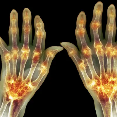 Артроз рук - симптомы, причины, профилактика