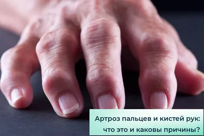 Артроз пальцев и кистей рук | ИМПЛЭСО® - лечение артроза | Дзен