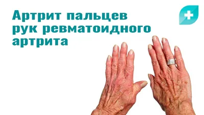 Артрит пальцев рук ревматоидного артрита: причины, симптомы и лечение -  YouTube