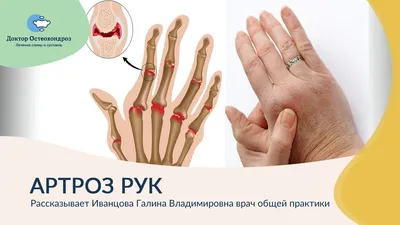 Артроз рук. Симптомы, причины и лечение - YouTube
