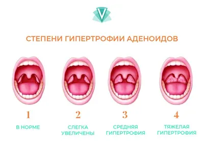 Удаление аденоидов в Одессе - клиника VIRTUS