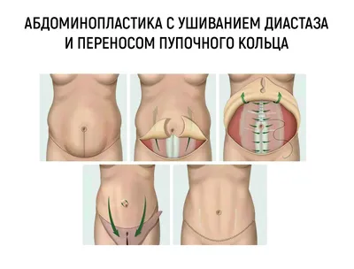 Абдоминопластика (пластика живота) в Новосибирске по выгодной цене в  клинике АвисМед