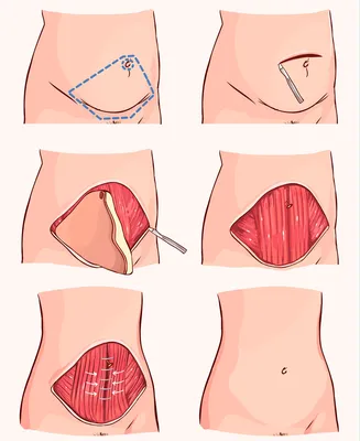 Абдоминопластика в Москве | Пластика живота в клинике Westmed: цены, методы