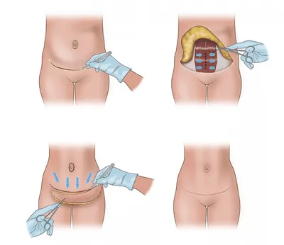 Абдоминопластика - пластика живота в Челябинске | Клиника пластической  хирургии \"Молдинг Маск\"