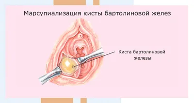 Киста половой губы: причины, симптомы, диагностика, лечение, операция в  клинике «АльтраВита»