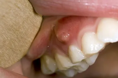 Гнойник на десне (абсцесс десны, зуба) – что делать, виды, методы лечения