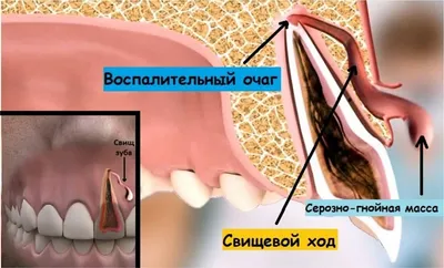 Абсцесс десен – причины, симптомы и лечение