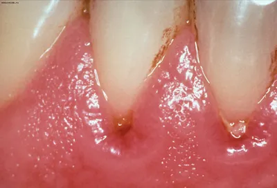Абсцесс зуба - симптомы, причины и виды лечения ДЕНТиК ЛЮКС