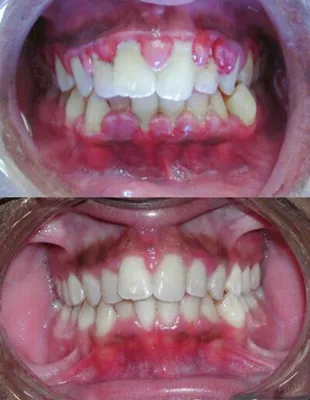 Абсцесс зуба - что такое и чем опасен | Центр Ортодонтии | Дзен