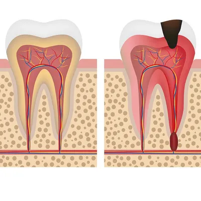 Воспаление зуба: симптомы и лечение