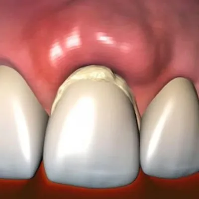 Абсцесс зуба: методы диагностики, профилактики и способы лечения