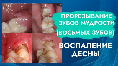 Причины и симптомы воспаления десен