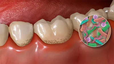 Абсцесс зуба: какие симптомы и что с ним делать