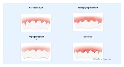 Основные причины воспаления десен под коронками | Центр Современной  Стоматологии, Москва