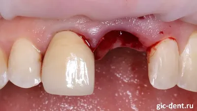 Абсцесс зуба - что это, почему опасно, как лечить гнойник