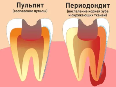Инфильтрационная анестезия - Сеть стоматологических клиник Санкт-Петербурга  - Мир стоматологии