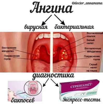 Фарингит: признаки, симптомы, лечение - МедКом