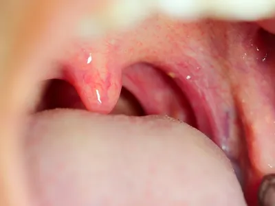Глоссит — воспаление языка Причины, Лечение, Профилактика