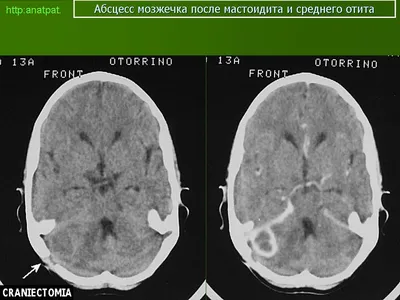 Абсцесс головного мозга | Ассоциация врачей МРТ и КТ