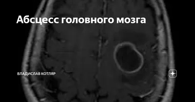 medicine_live_case. Абсцесс головного мозга | ВКонтакте