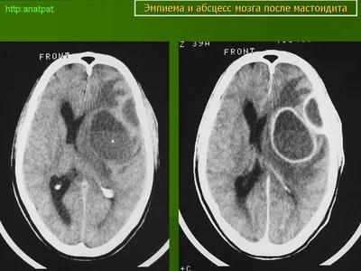 Абсцесс головного мозга