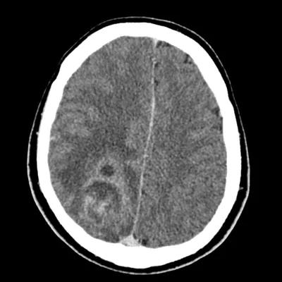 Абсцесс головного мозга | Радиография