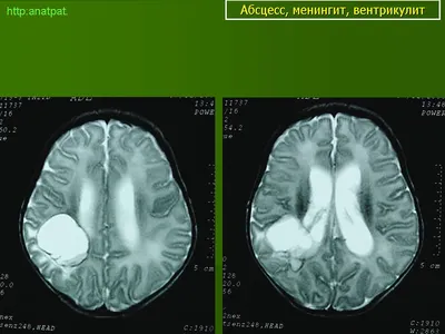Абсцесс головного мозга - Заболевания ЦНС. Нейропатология - Судебная  медицина от Forens.ru