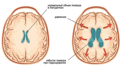 Абсцесс головного мозга - все о заболевании на MRT-vMSK