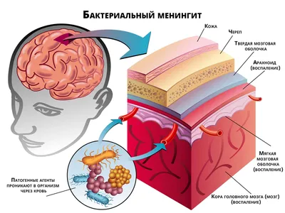 Хирургические аспекты в лечении абсцессов головного мозга – тема научной  статьи по клинической медицине читайте бесплатно текст  научно-исследовательской работы в электронной библиотеке КиберЛенинка