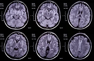 Отогенный абсцесс мозга и мозжечка, лечение в Москве