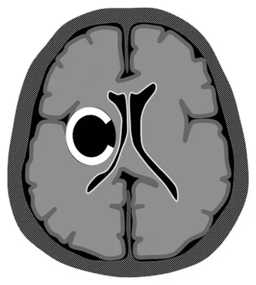 абсцесс мозга. абсцесс головного мозга. поперечный участок человеческого  мозга с интрацеребральной коллекцией толкача Иллюстрация вектора -  иллюстрации насчитывающей концепция, раздел: 250683144