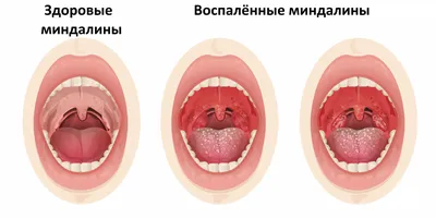Ответы Mail.ru: волдыри на задней стенке горла. абсцесс?