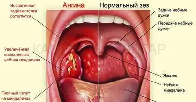 Воспаление горла, лечение, как выглядит, почему воспаляется горло — блог  Фурасол®