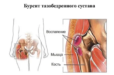 У женщины развился тяжелый сепсис спустя год после введения филлеров в  ягодицы - новости медицины