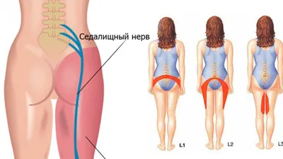 Бурсит тазобедренного сустава: причины, симптомы и лечение