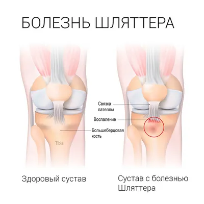 При выпрямлении ноги болит колено: причины, пульсация и методы лечения